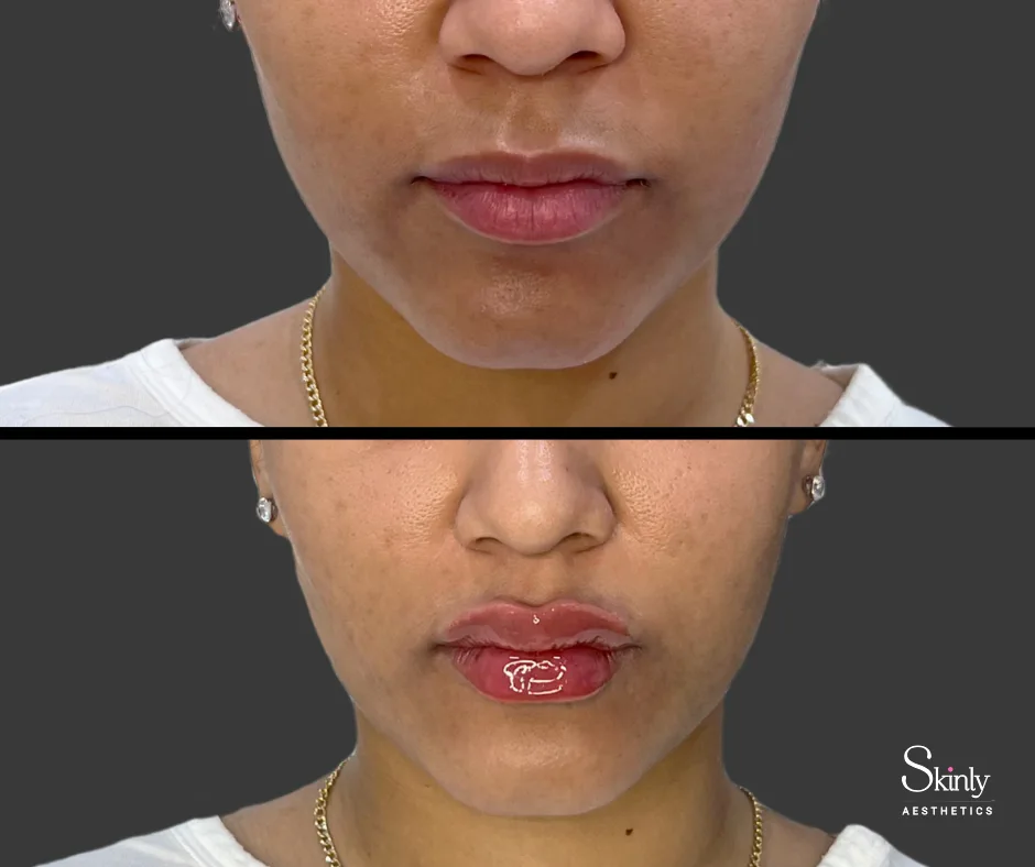 Natural lip filler results and a subtle transformation in New York City.
