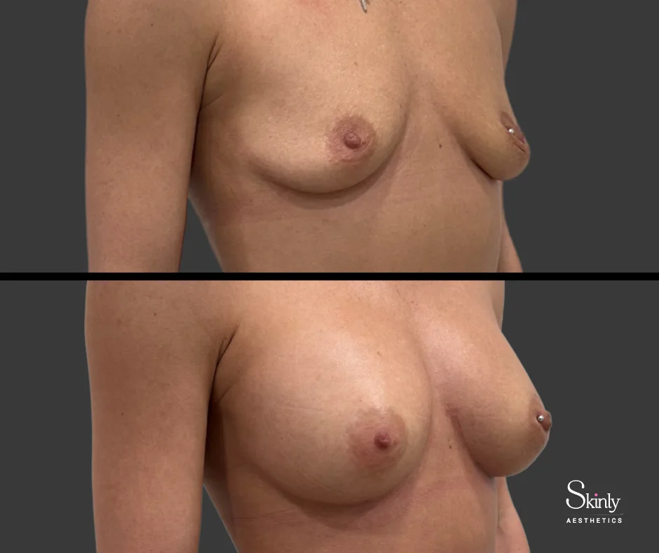 Lifted breasts after non-surgical breast enhancement at Skinly Aesthetics.