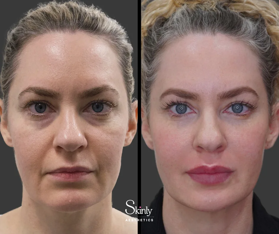 Rejuvenated appearance after non-surgical facelift at Skinly Aesthetics in NYC.