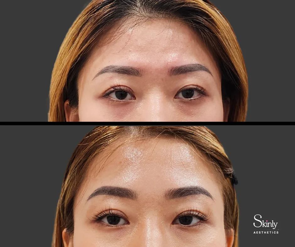 Restored youthful appearance after forehead filler in NYC.