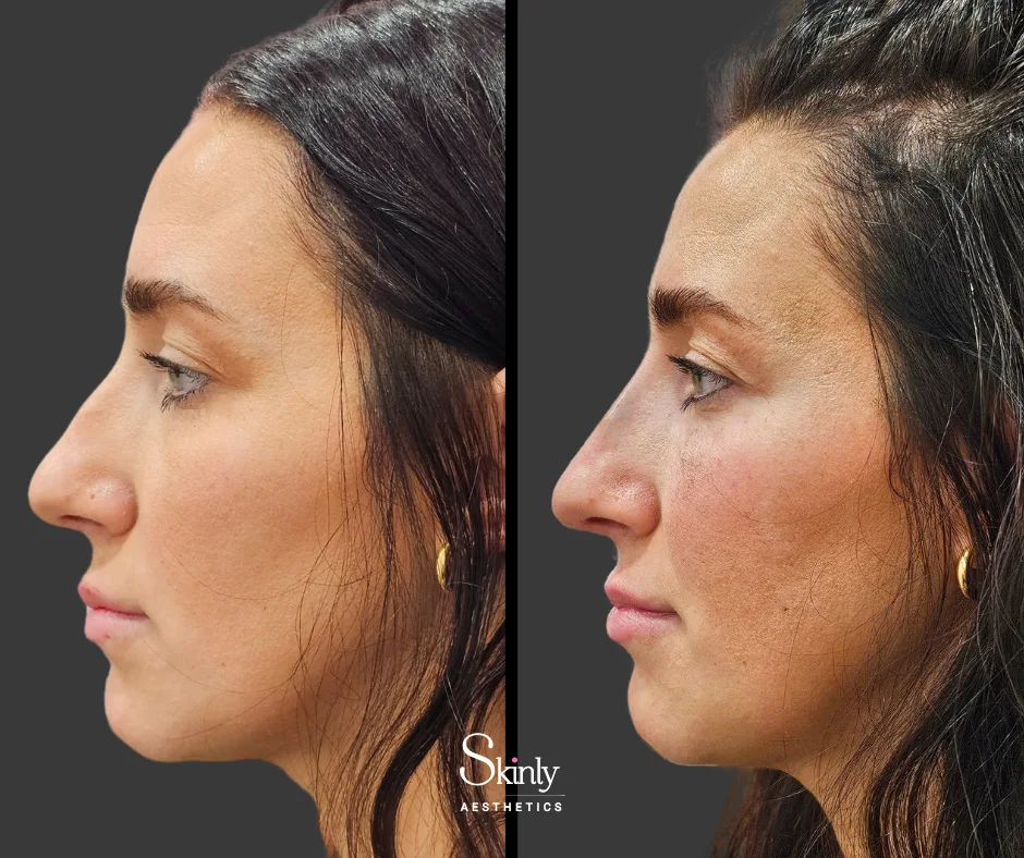 Symmetrical profile after liquid rhinoplasty performed by Dr. Schwarzburg.