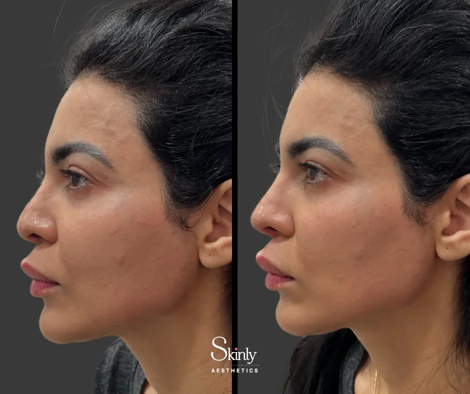 Straighter, more defined profile after non-surgical rhinoplasty.