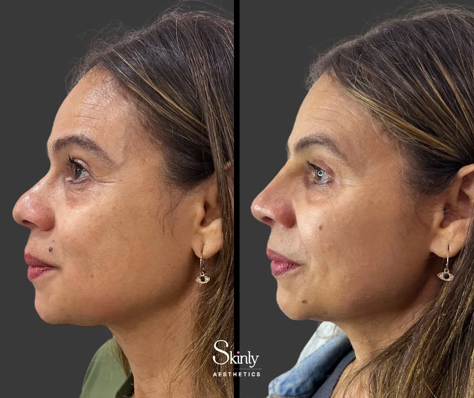 Balanced nasal bridge proportions – performed at Skinly Aesthetics in New York City.