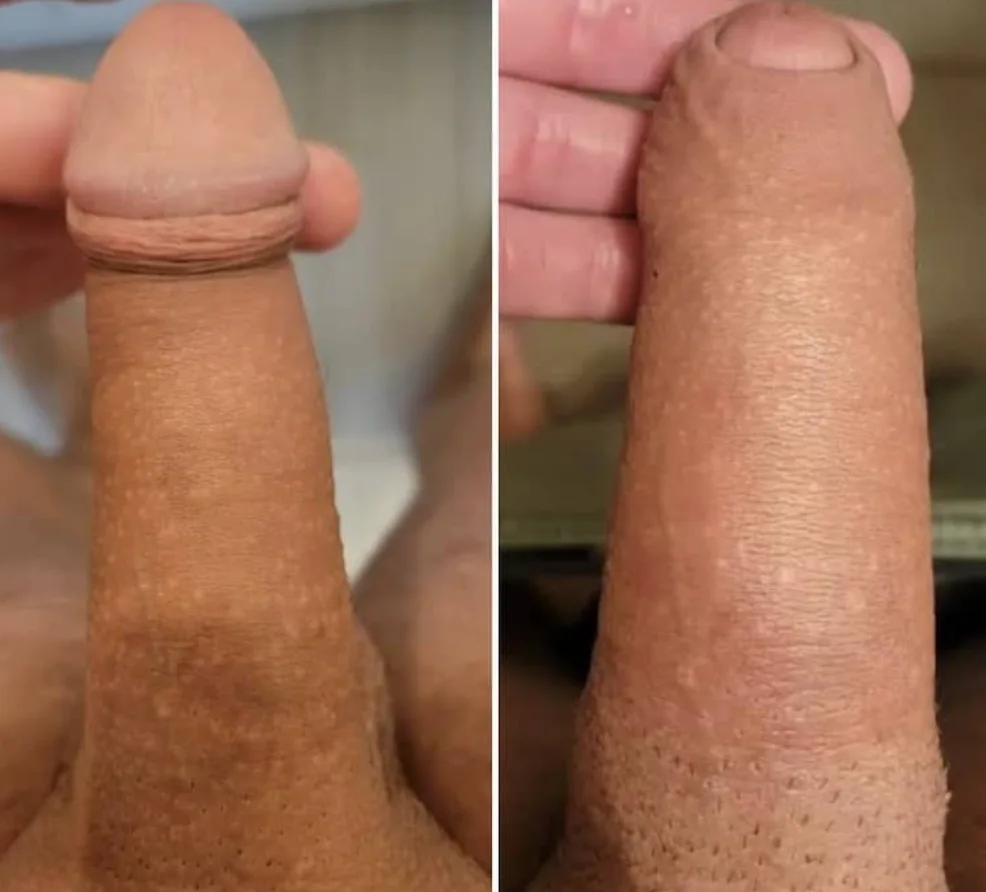 Significant increase in size after non-surgical penile enlargement in New York.