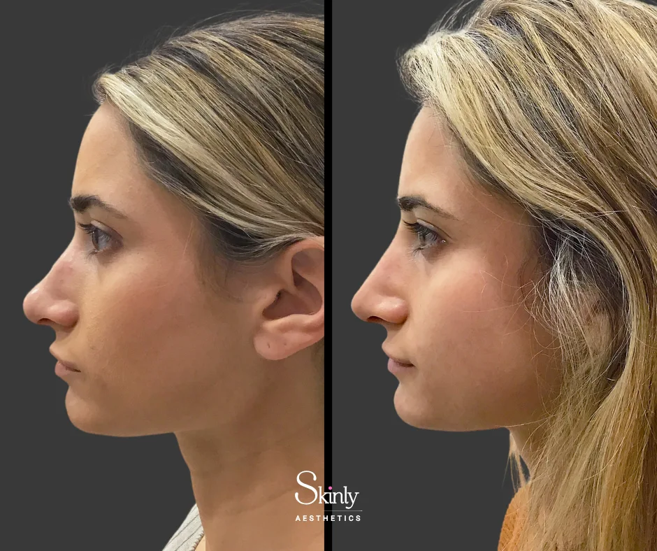 Straightened nasal bridge after Non-surgical rhinoplasty.