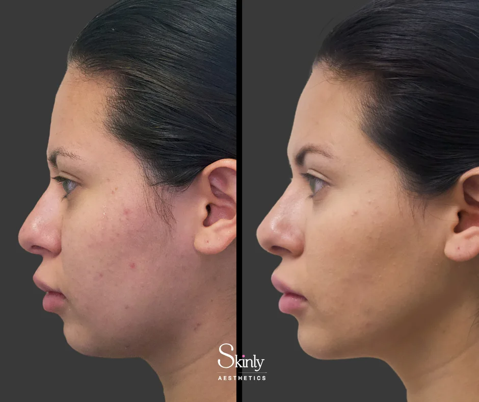 Straightened bridge after nose filler.