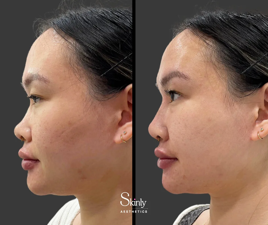 Nose tip filler improving projection and symmetry in New York.