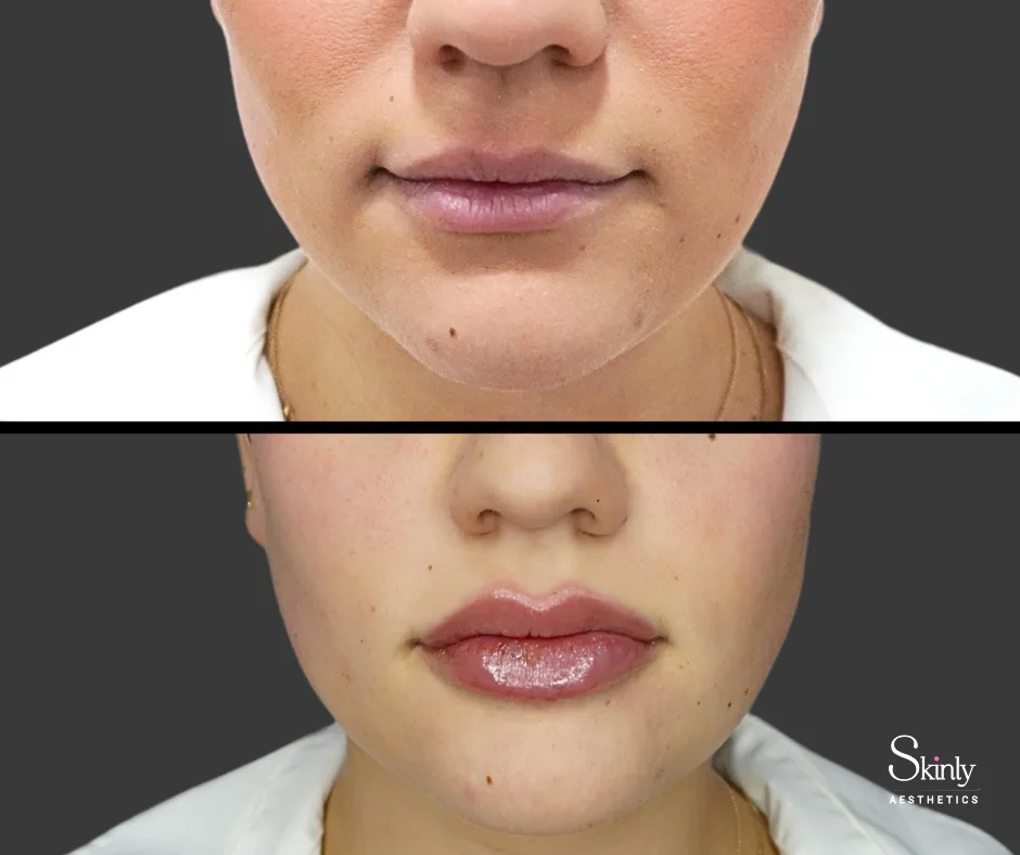 Lip filler treatment creating plumper lips – at our NYC medical spa.