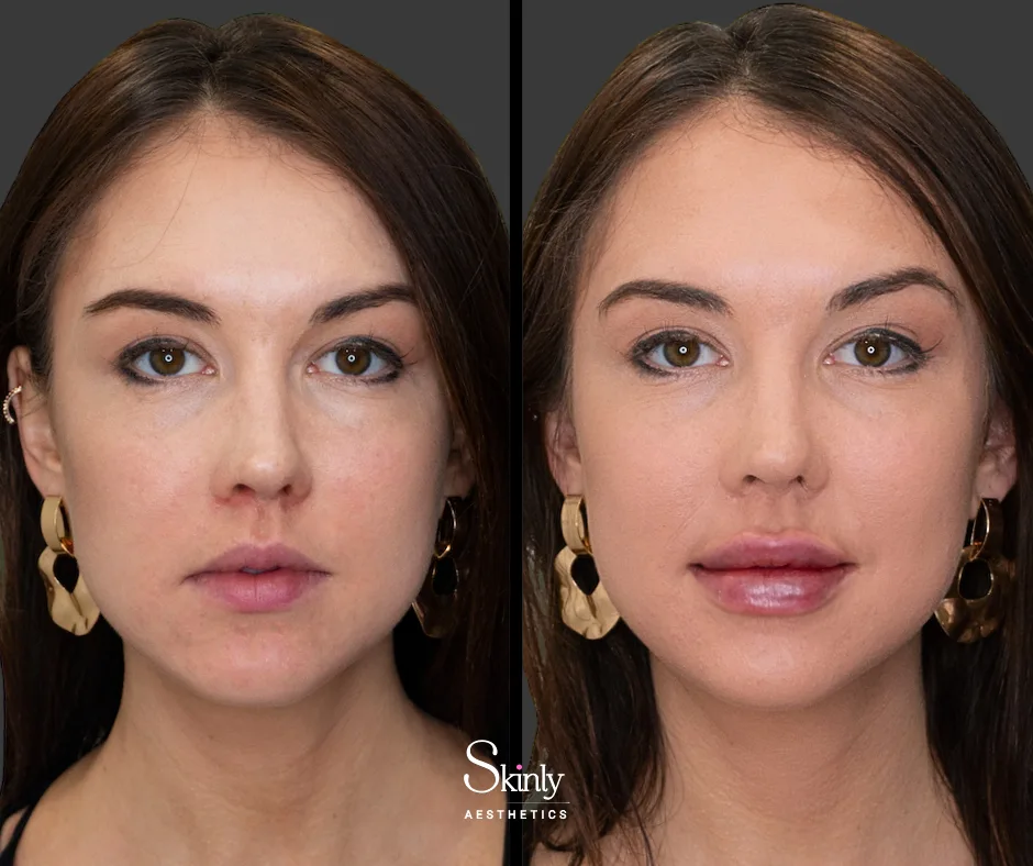 Defined cupid’s bow with Russian lip technique by Dr. Schwarzburg.