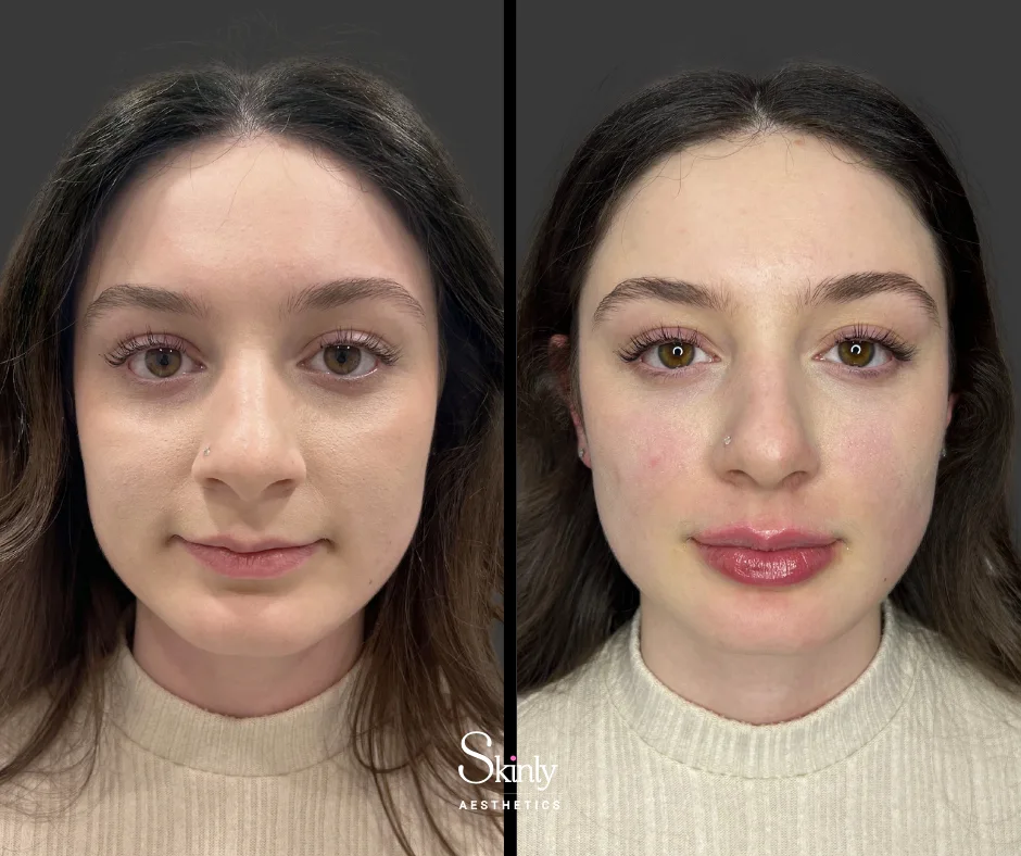 Subtle volume and definition after Russian lip filler at our NYC clinic