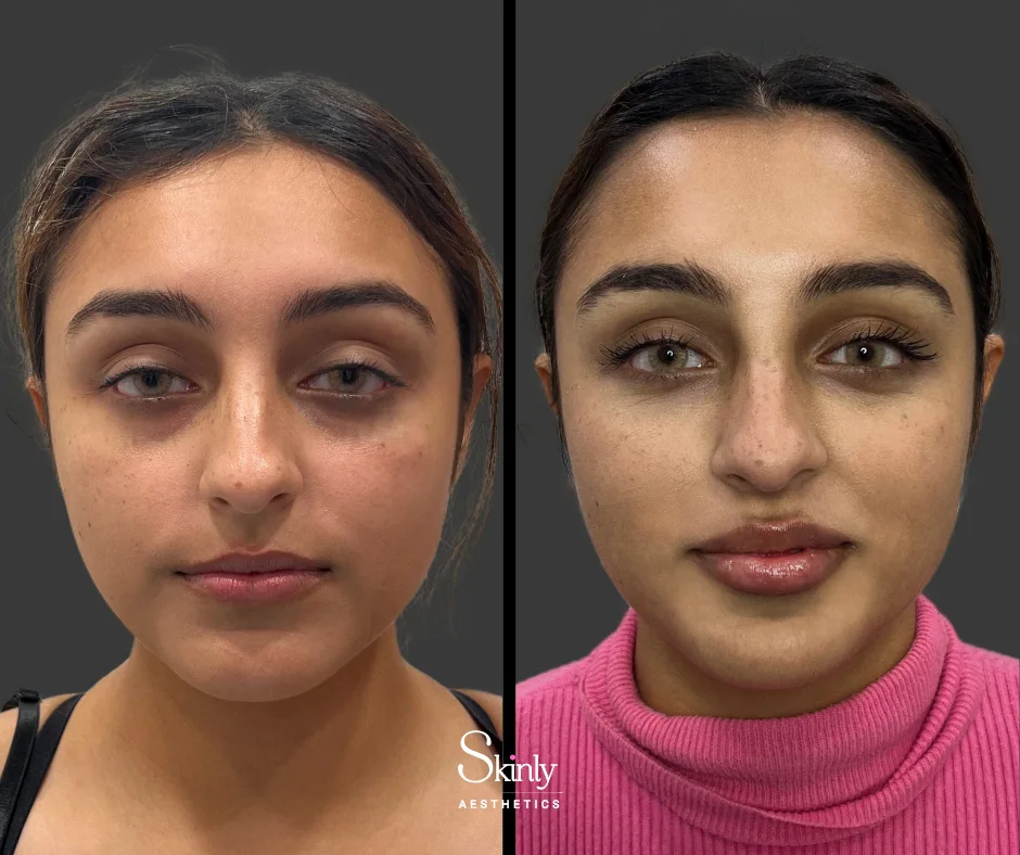 Russian lip filler technique, enhancing symmetry and fullness at Skinly Aesthetics Medical Spa.