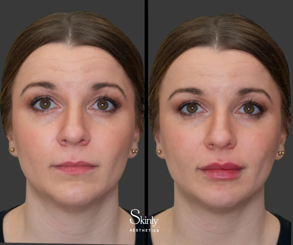 Natural-looking lip enhancement with Russian lip filler – before (left) vs after (right) in NYC.