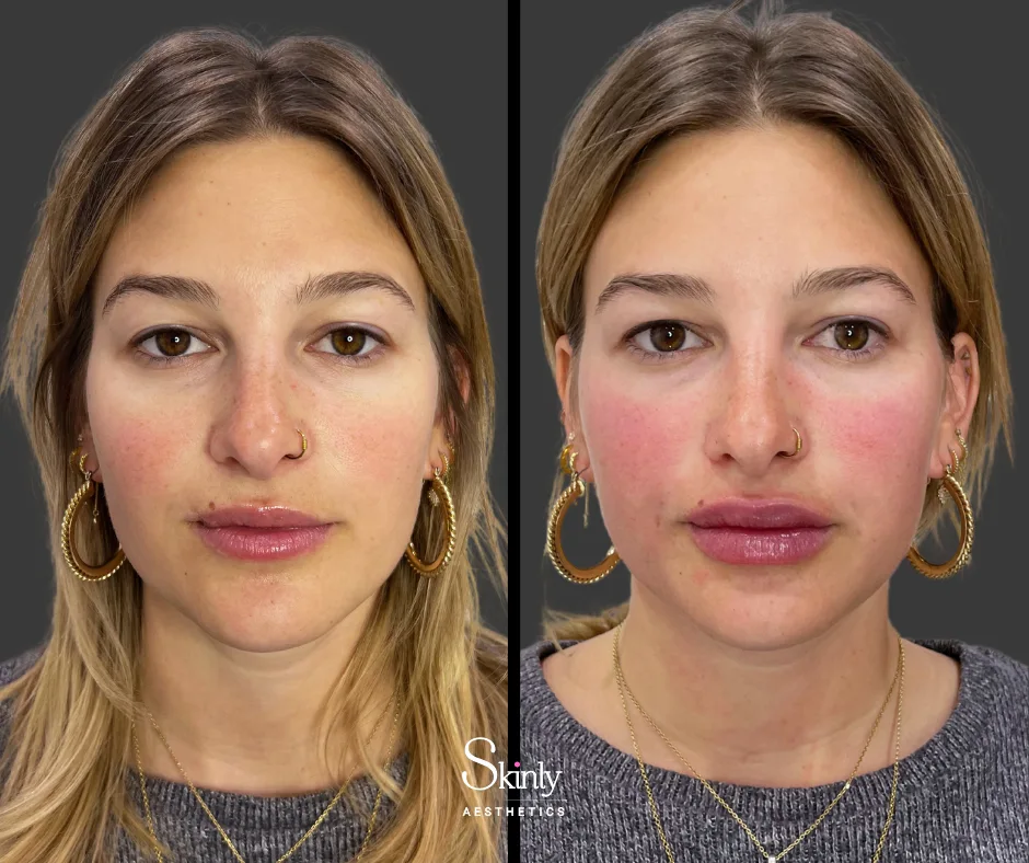 Smooth and rejuvenated lips after Russian lip injections.