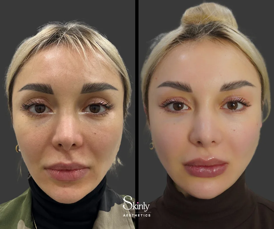 Fuller, more defined lips after Russian lip technique.