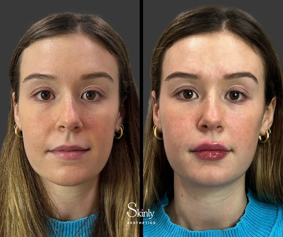 Subtle, natural-looking results after Russian lip filler by Dr. Schwarzburg.