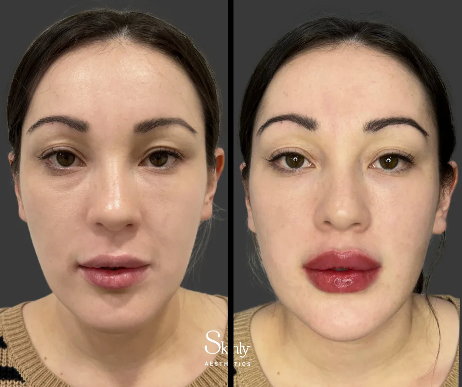 Vertically enhanced lip shape after Russian lip technique with filler.