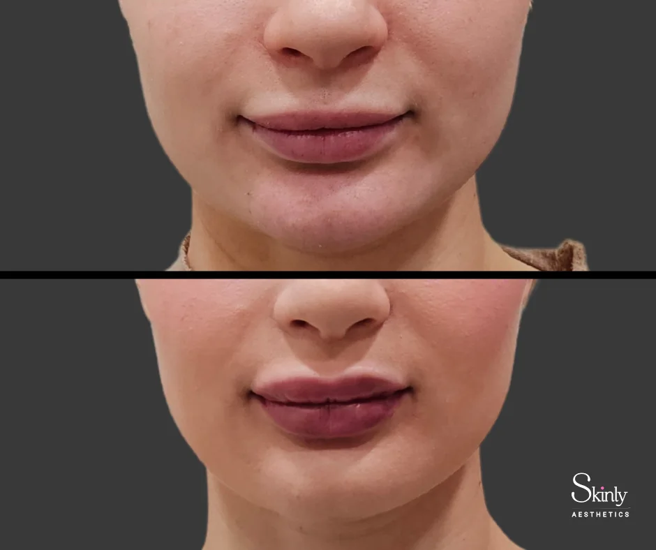 Increased plumpness with Russian lip technique in New York.