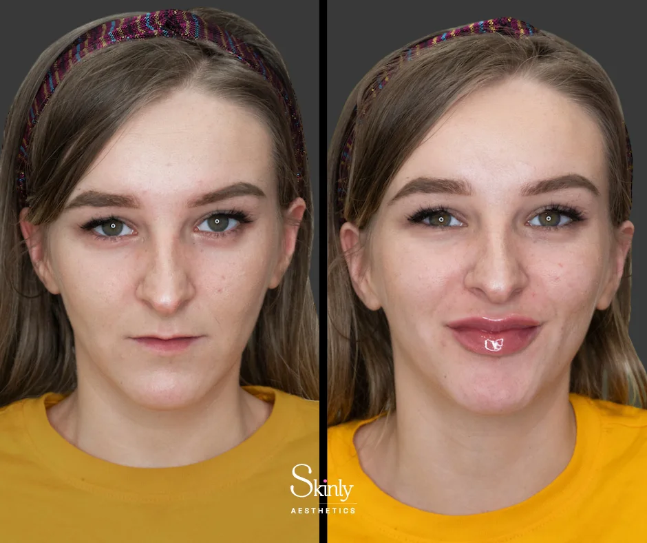 Natural-looking fullness after Russian lip technique.