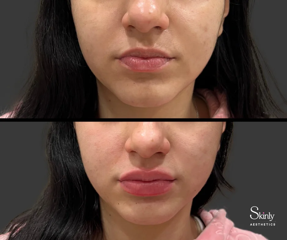 Refined and enhanced lip ship after Russian lip injections.