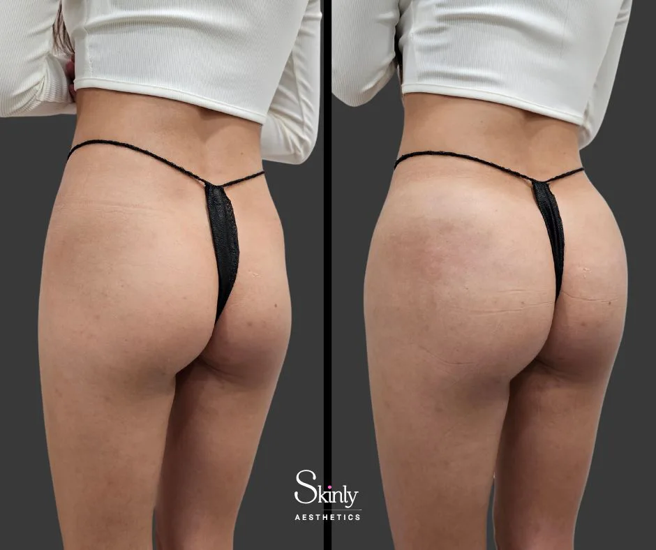 Before and after Sculptra butt augmentation showing round gluteal shape
