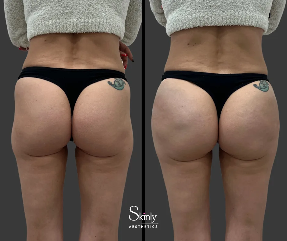 Before and after Sculptra hip dip correction showing natural curve restoration.