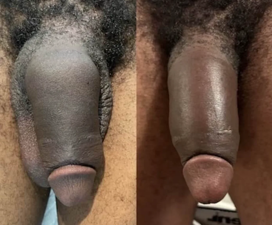 Improved penile width after penile filler performed by Dr. Schwarzburg in NYC.