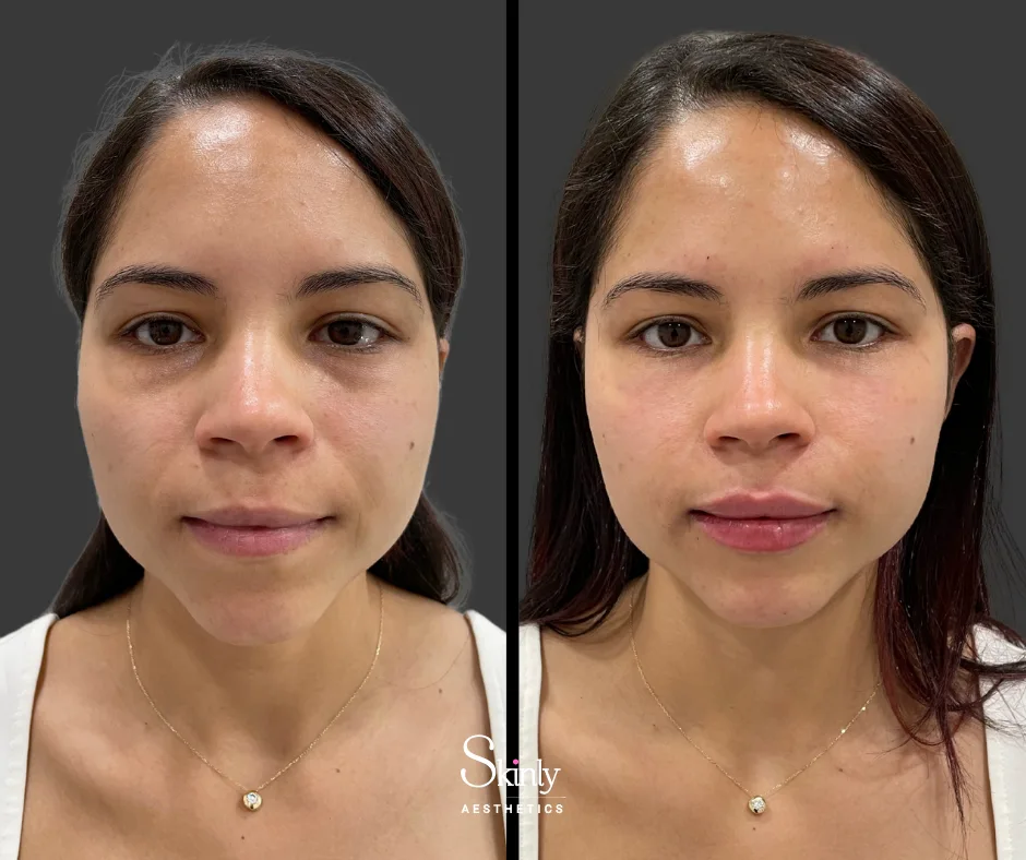 Refreshed, natural appearance after smile line correction with filler.