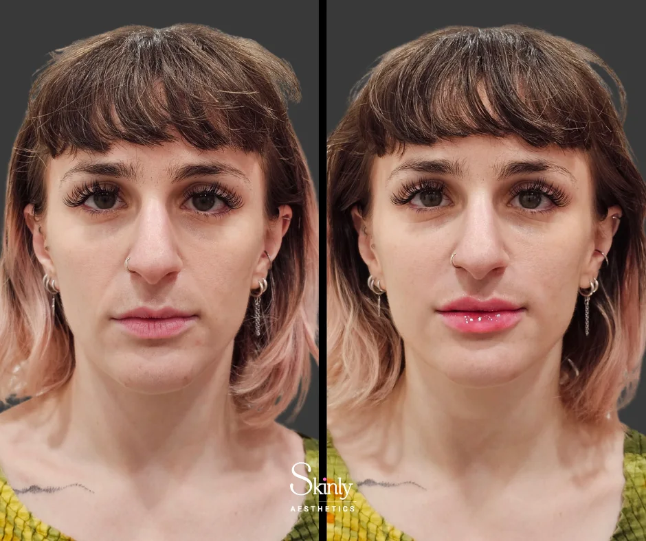 Smile line filler softening deep creases – at Skinly Aesthetics in New York City.