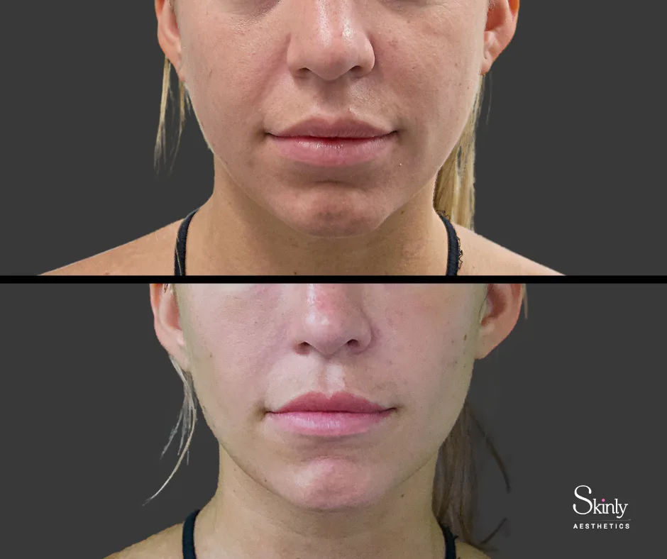 Youthful appearance after smile line filler injections in New York City.
