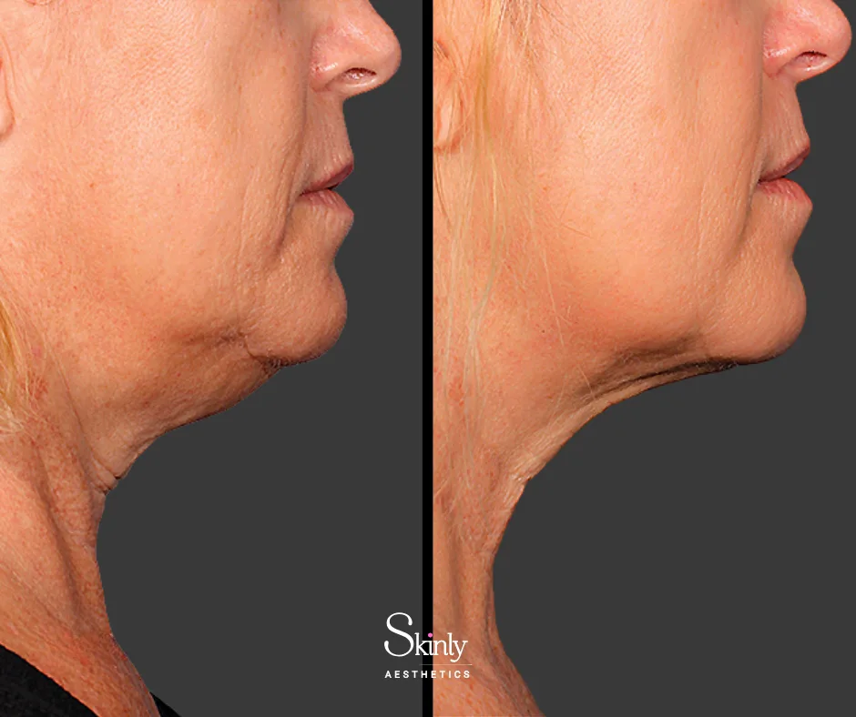 Submental fat reduction after Kybella treatment – before (left) vs after (right).