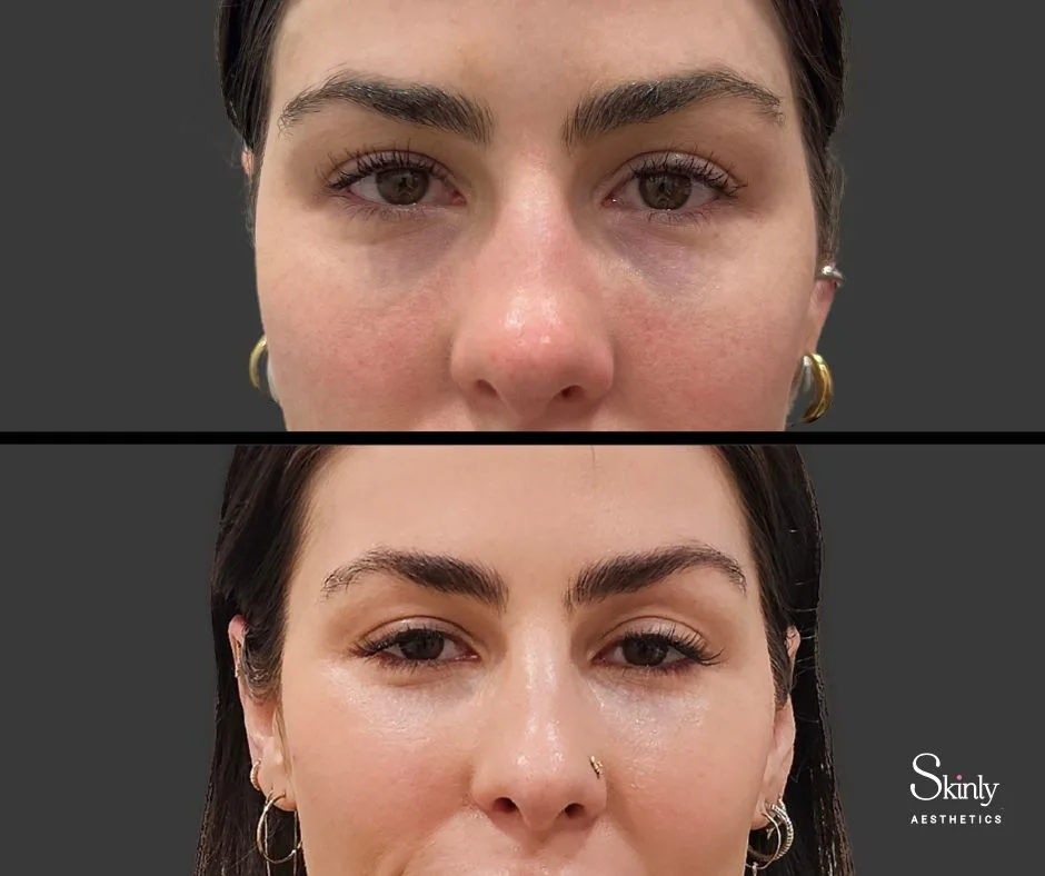 Tear trough correction with filler improving under eye contours.