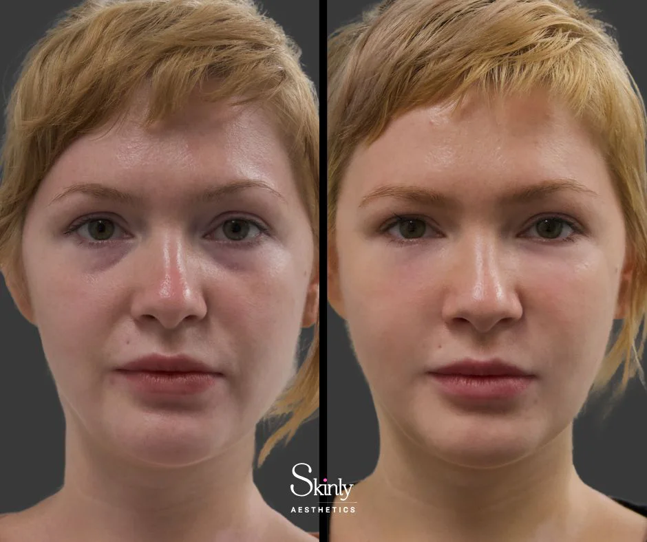 Tear trough filler correcting hollowness and brightening the eyes at Skinly Aesthetics in NYC.