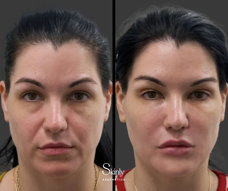 Tear trough filler brightening under eye hollows – by Dr. Schwarzburg in NYC.