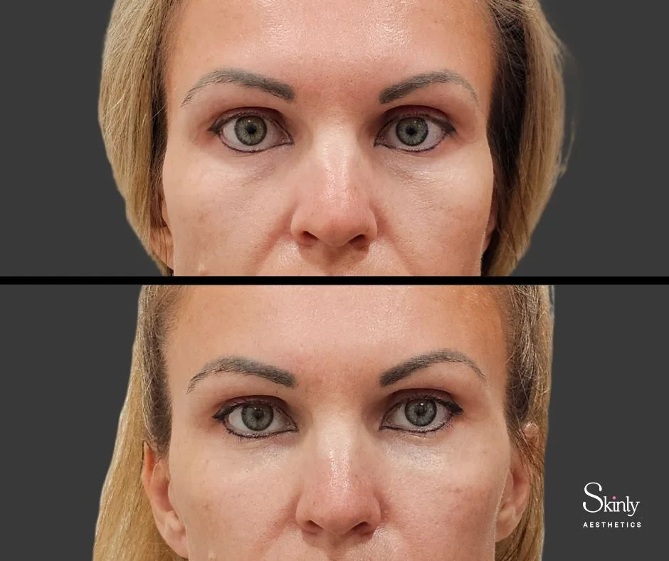 Brightened tear troughs after dermal filler injections.