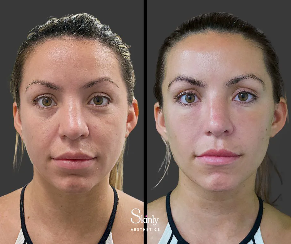 Volume restored and hollowness corrected after under eye filler injections.