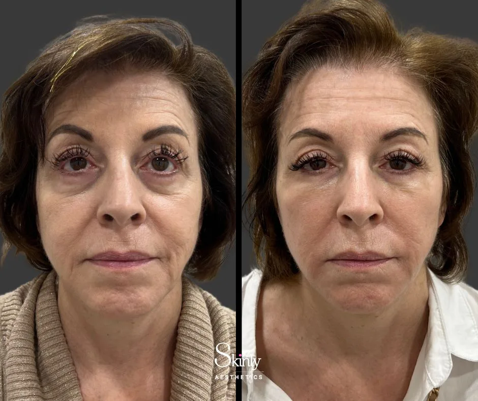 Under eye filler reducing dark circles – before (left) vs after (right) in NYC.