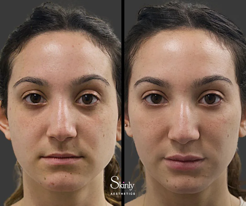 Rejuvenated under eye area after dermal filler injections at NYC medspa.