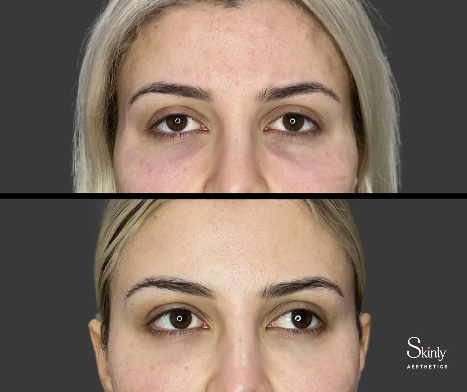 Under eye volume restored after under eye injections.