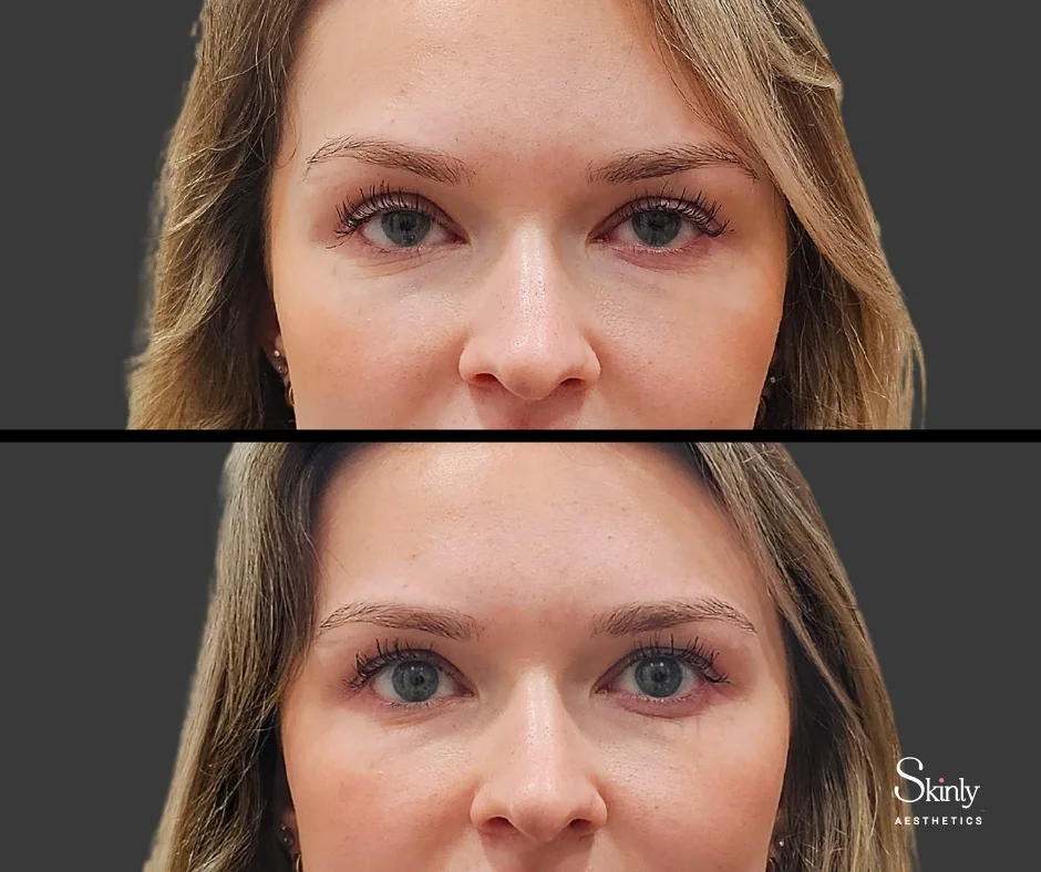 improved eyelid position after Upneeq eye drops in New York City.
