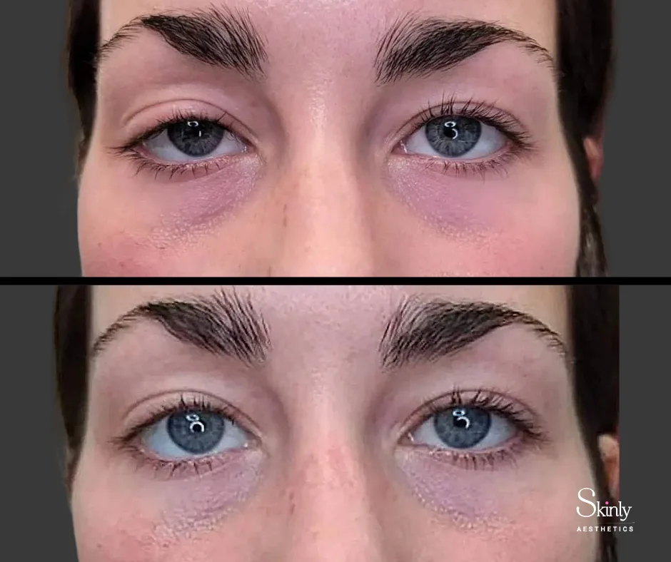 Balanced eyelids and reduced drooping after Upneeq.