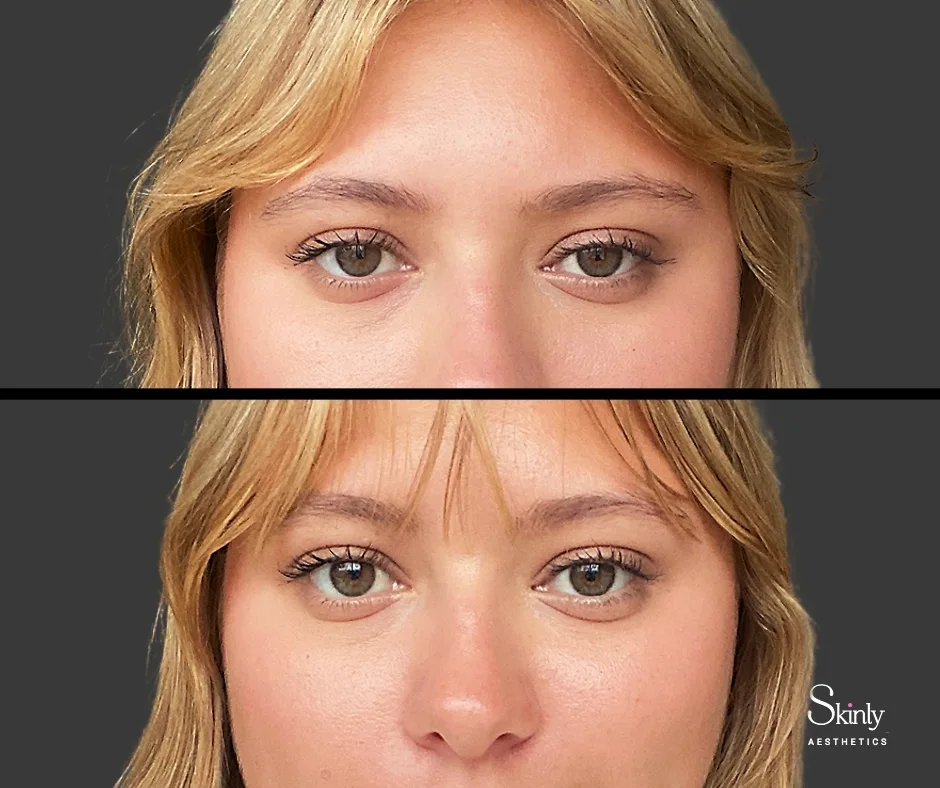 Visible upper lid lift after Upneeq – top photo before, bottom after – at Skinly Aesthetics in NYC.