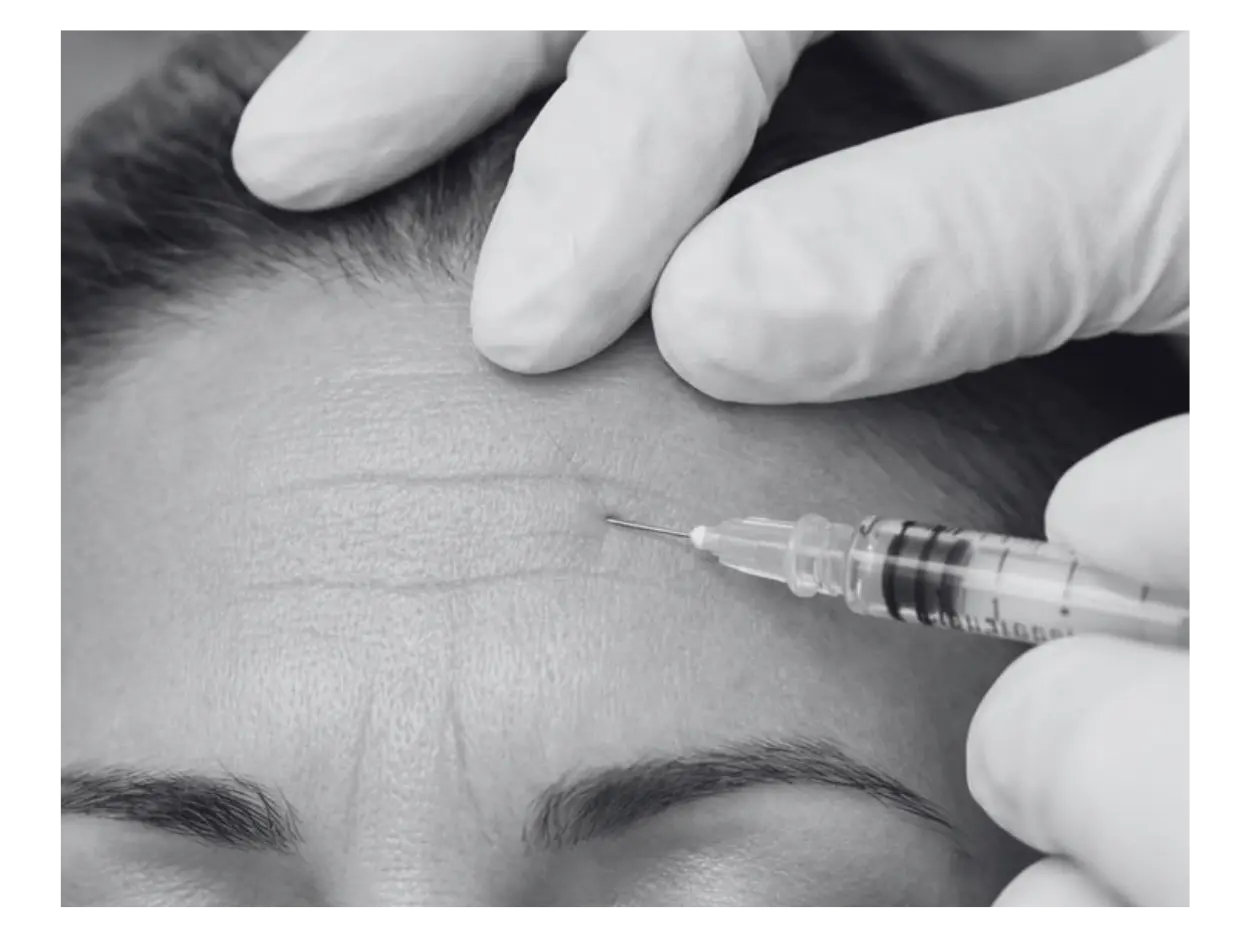 BOTOX INJECTION