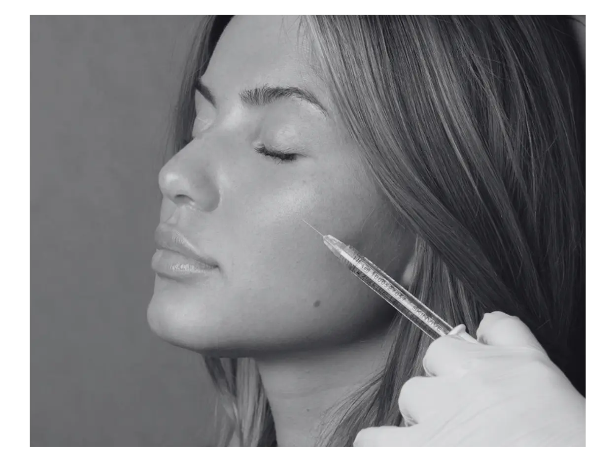 RADIESSE TREATMENTS