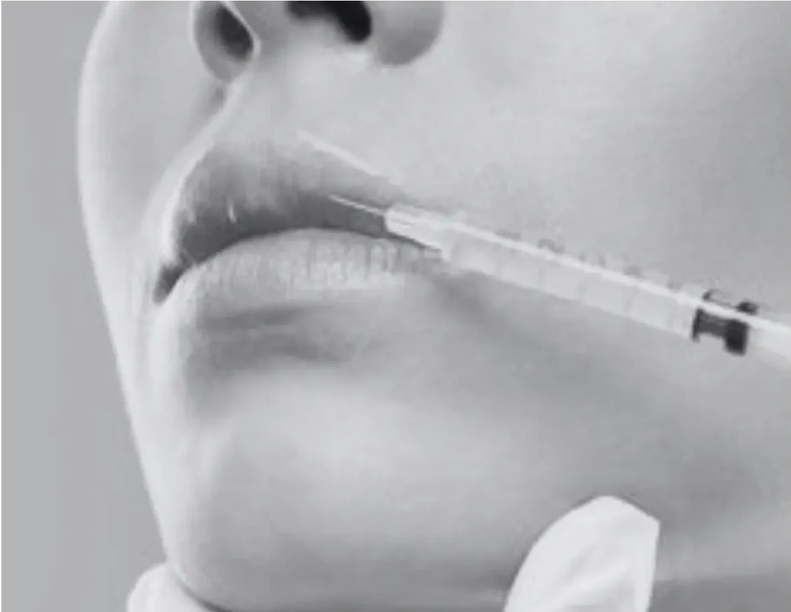 LIP FILLER INJECTIONS