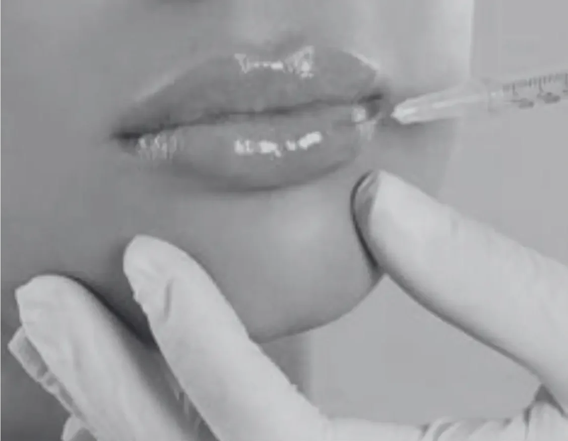 RUSSIAN LIP FILLER TECHNIQUE
