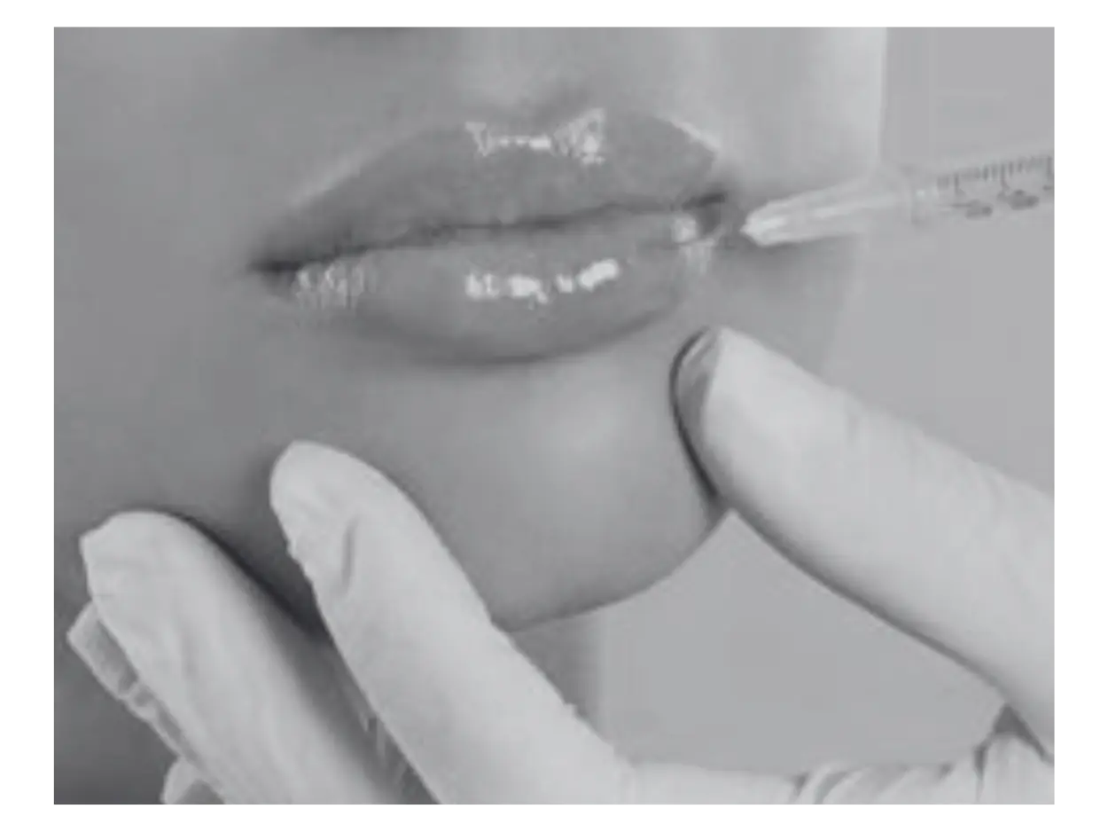 RUSSIAN LIP FILLER TECHNIQUE