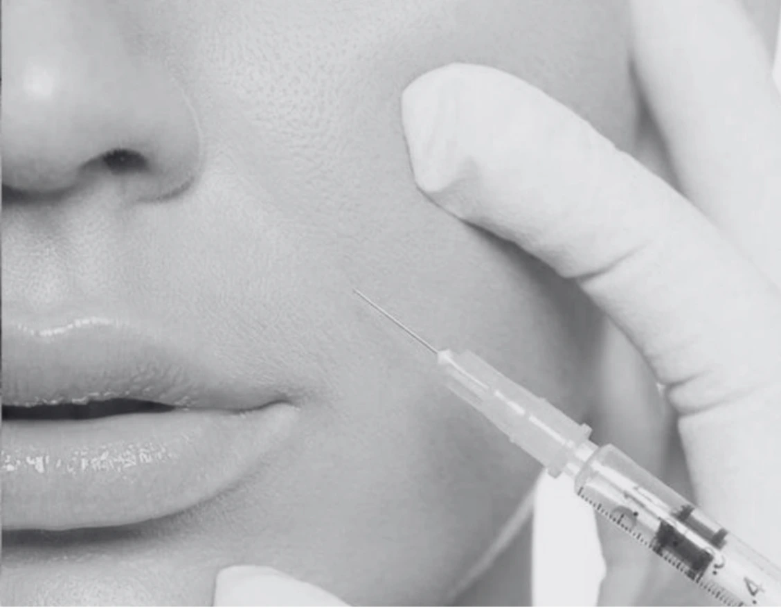 NASOLABIAL FOLDS INJECTION