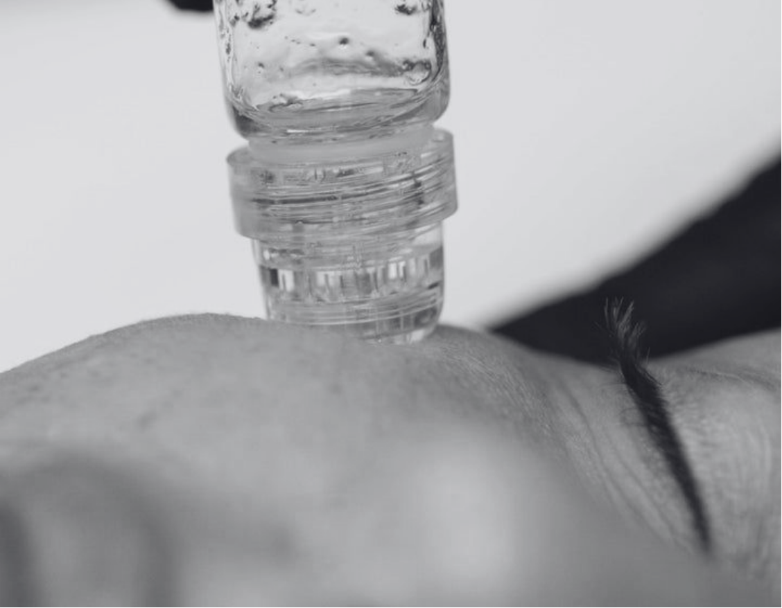 AQUAGOLD MICRONEEDLING
