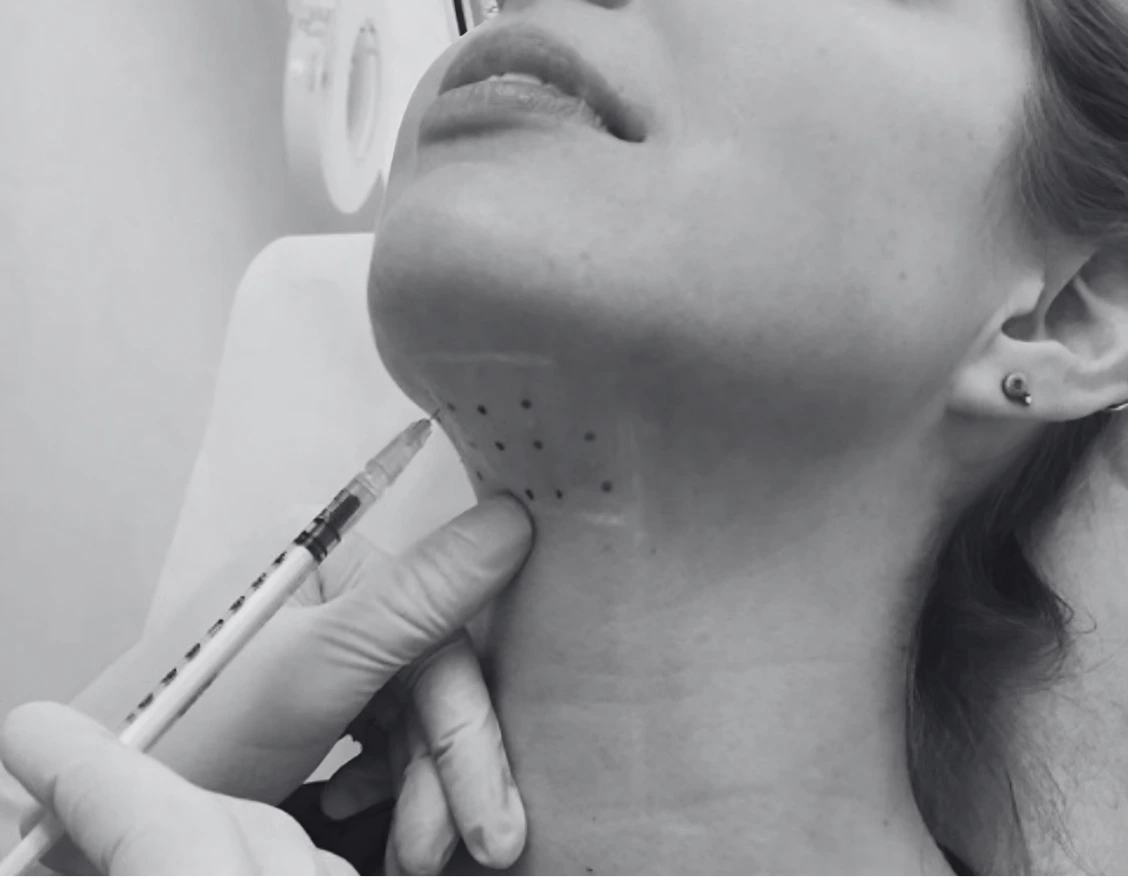 KYBELLA DOUBLE CHIN INJECTIONS