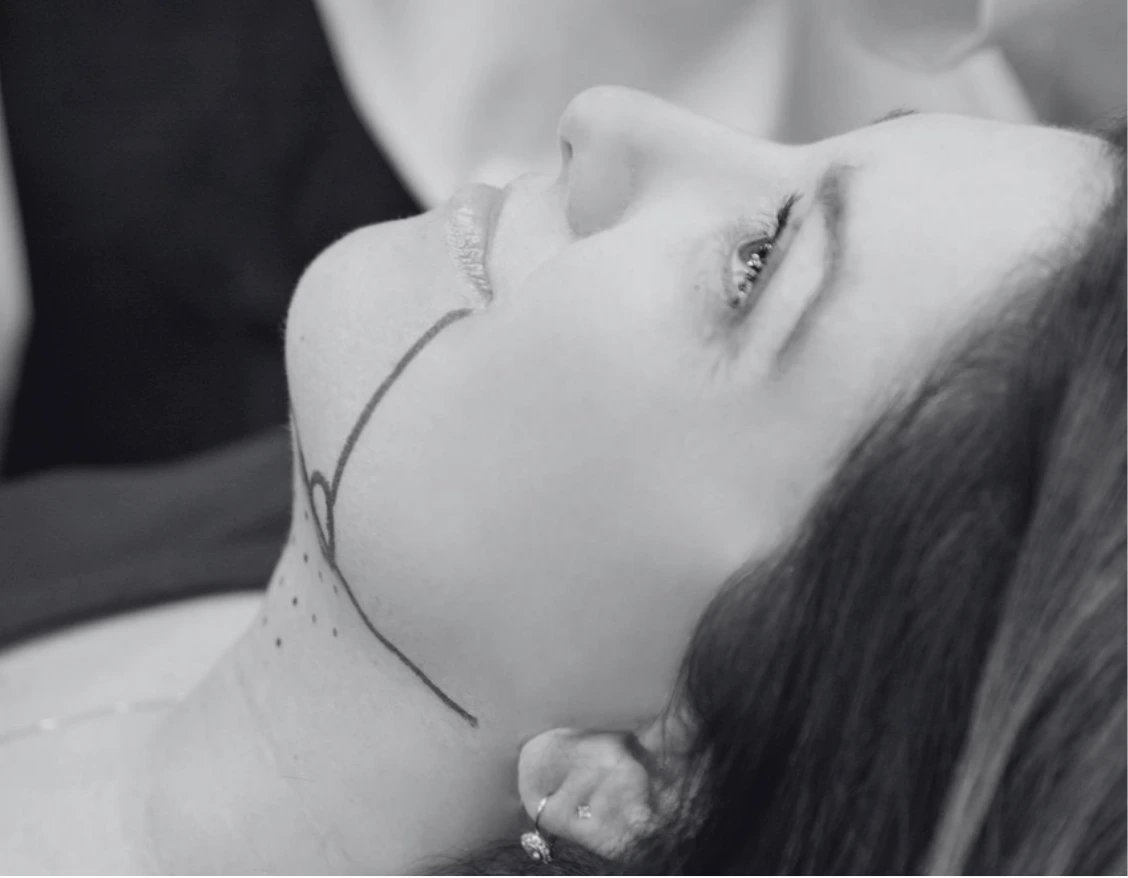KYBELLA JOWLS TREATMENT